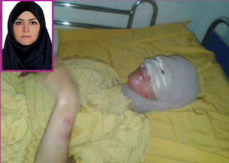 پدری صورت دخترش را با اسید سوزاند